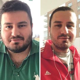 VORHER NACHER BILDER DER PATIENTEN