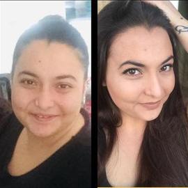 VORHER NACHER BILDER DER PATIENTEN