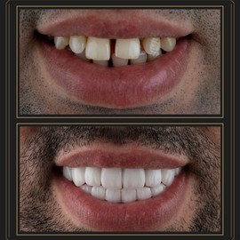 Hollywood Smile-1