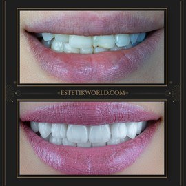 Hollywood Smile-2