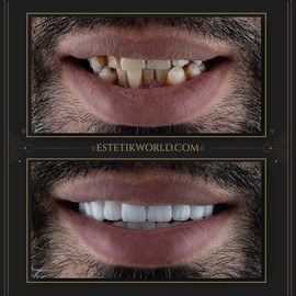 Hollywood Smile-5
