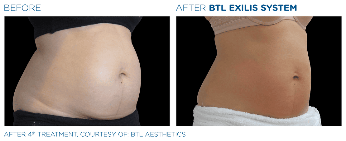 BTL_Exilis_system_PIC_Ba-card-female-abdomen-006_EN100