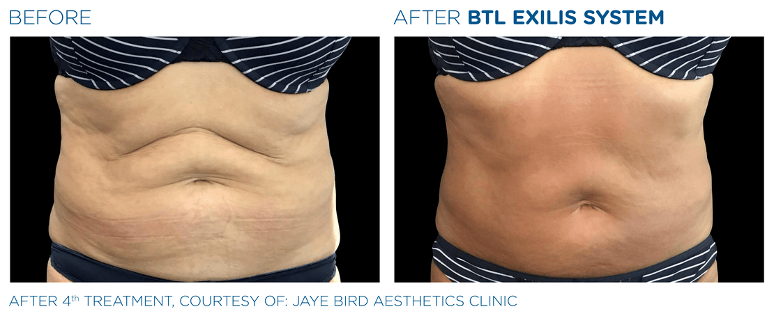 BTL_Exilis_system_PIC_Ba-card-female-abdomen-007_EN100