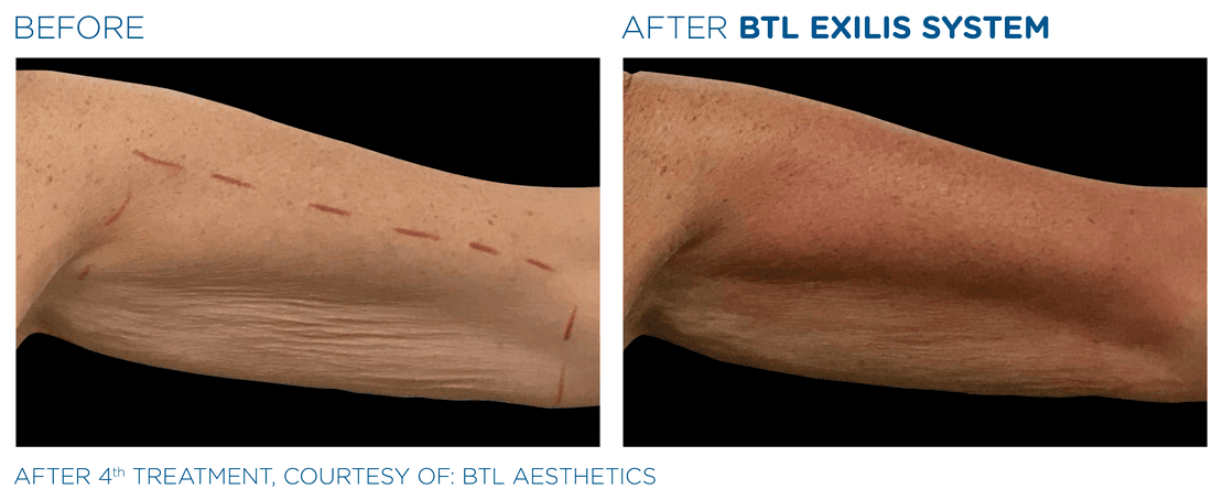 BTL_Exilis_system_PIC_Ba-card-female-arms-009_EN100