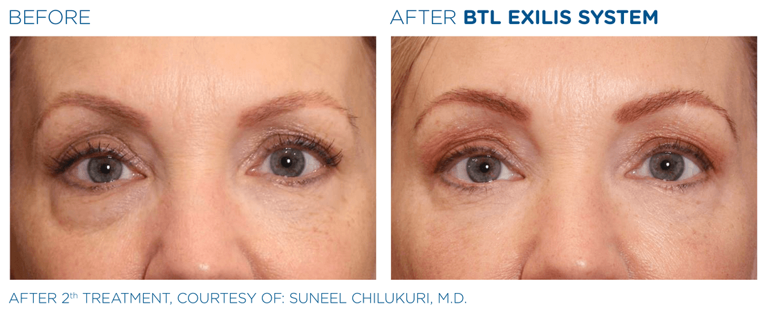 BTL_Exilis_system_PIC_Ba-card-female-eyes-015_EN100