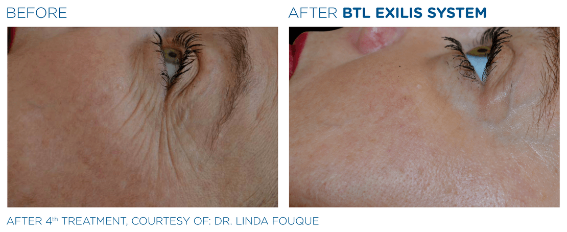 BTL_Exilis_system_PIC_Ba-card-female-eyes-021_EN100