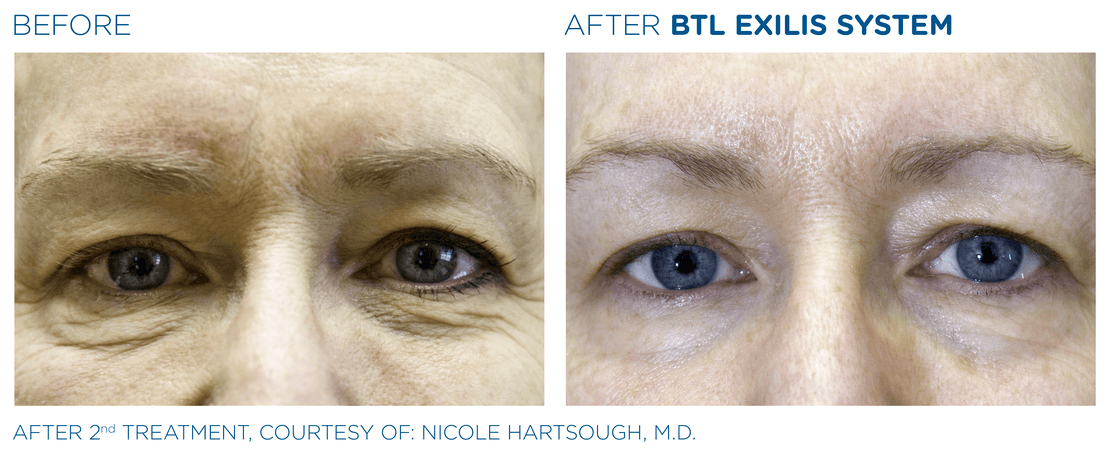 BTL_Exilis_system_PIC_Ba-card-female-eyes-024_EN100