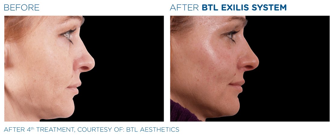 BTL_Exilis_system_PIC_Ba-card-female-face-011_EN100