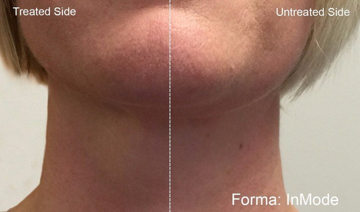 IM_Forma_1a_Neck_After10Min[1]