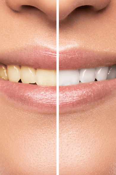 Teeth Whitening