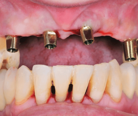 All on 4 dental implant