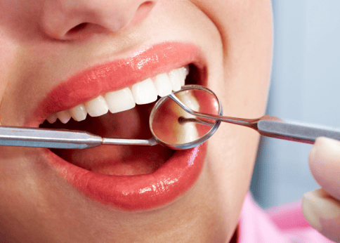 All on 4 Dental implant