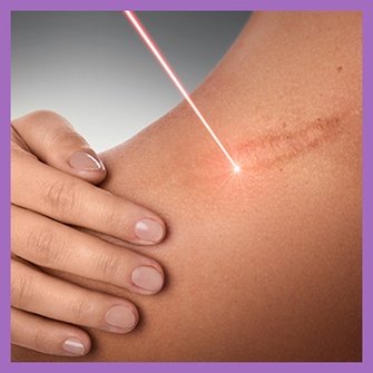 Yara İzlerinin Tedavisinde Lazer Uygulaması