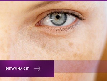 lazerle_çil_tedavisi_yaptıranların_yorumları