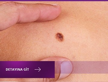 iyi_huylu_deri_tümörü_bursa