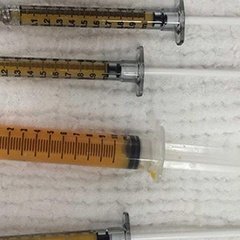 "Bugünkü operasyonu bu işlemlerin etkinliğini arttıran yağ dolguları ile bitirdik. Kişinin kendi yağ hücrelerinden oluşan bu dolgular hem kalıcılığın yüksek olması hem de alerji riskini ortadan kaldırması bakımından..." instagram.com/dralitufansoydan