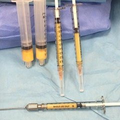 "Yağ dolguları işleme hazır! Bugün yaptığımız orta yüz germe, yanak kaldırma ve göz kapağı estetiği operasyonları esnasında karın bölgesinden alınan yağ dolguları yüz bölgesine uygulanmak üzere sırasını bekliyor..." instagram.com/dralitufansoydan