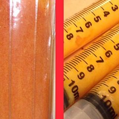 Lazer liposuction işlemi ile aldığımız yağları ne mi yapıyoruz? Şöyle özetleyelim, bunları özel bir işleme tabi tuttuktan sonra hastamızın ihtiyacı olan bölgelerde yağ dolgusu olarak...