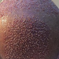 "Vertex (tepe) bölgesine ekim yapmak teknik ayrıntı ister. Kanallar helezonik döngüde açılır..." instagram.com/dralitufansoydan