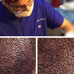 "Kliniğimizde hafta saç ekimi ile devam ediyor... Saç ekimi öncesi alınacak folikül sayısı, saçların alınacağı bölge üzerinde..." instagram.com/dralitufansoydan
