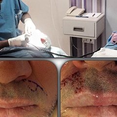 "Estetik ve plastik cerrahi yaratıcılık ister. Üst dudakta daha önce oluşmuş yaralara bağlı bıyık kaybı olan hastanın..." instagram.com/dralitufansoydan