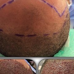 "Bugün saç ekim günüydü. Ön saç çizgisi oluşturma ayrıntılı bir çalışma gerektiriyor. 2375 kök ile bugün bunu başardık..." instagram.com/dralitufansoydan