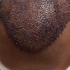 "Cumartesi akşamı saç ekimi ile bitti..." instagram.com/dralitufansoydan