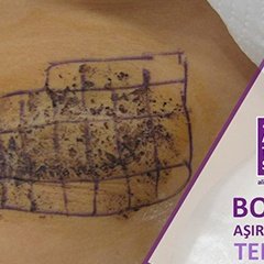 Botoksu sadece estetik amaçlı kullanmıyoruz. Koltuk altı, avuç içi ve ayak tabanı terleme tedavisinde...DEVAMI