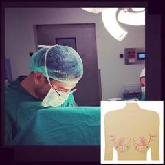 "Bugün meme küçültme ameliyatı ile bir hastamızın daha hem estetik kaygılarını giderdik hem de fiziksel olarak rahatlatmış olduk..." instagram.com/dralitufansoydan