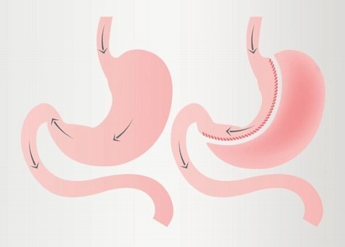 SLEEVE GASTRECTOMY 1