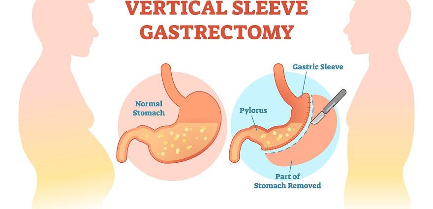 img-sleeve-gastrectomy-surgery