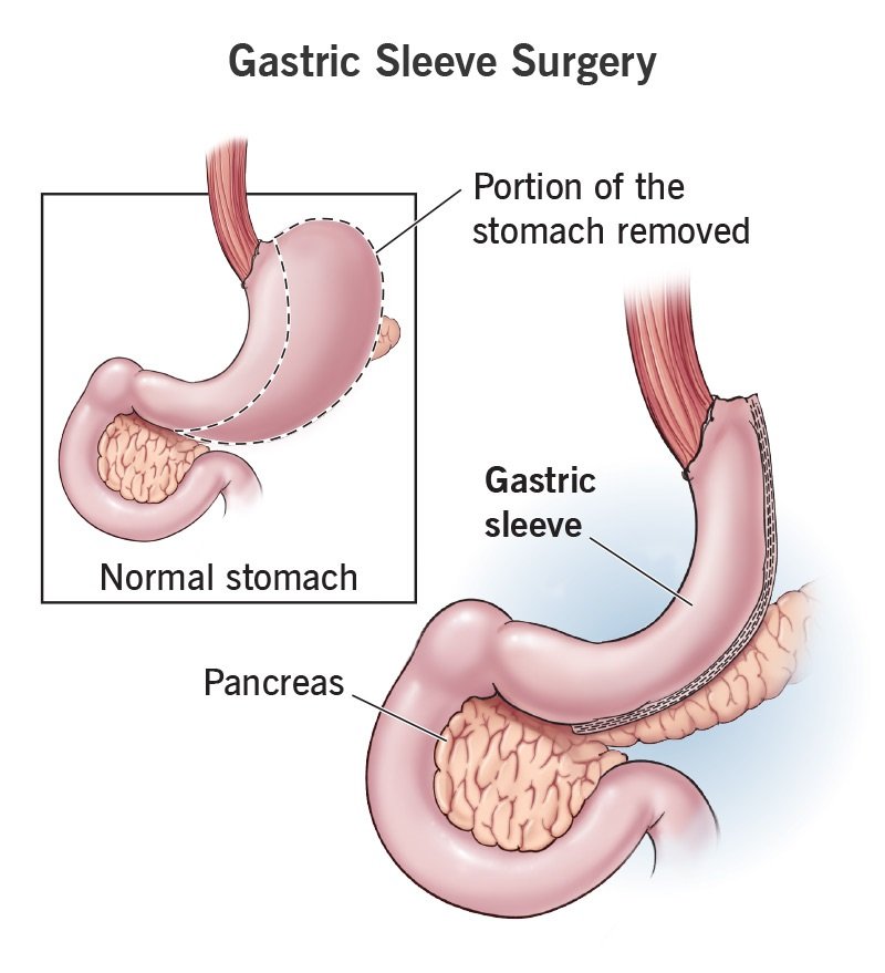 gastric-sleeve-surgery