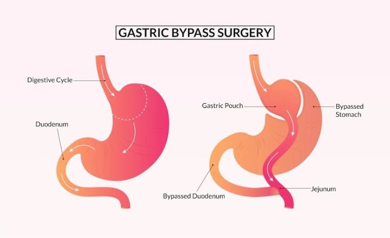 cirugía-bypass-gástrico-turquía