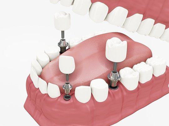 DİŞ İMPLANTLARI