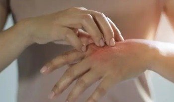 Deri Alerjisi Nedir?