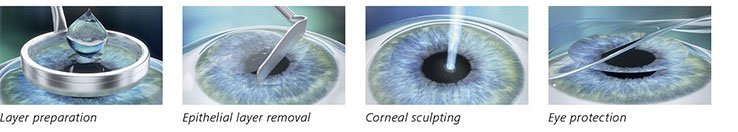 prk lasek laser eye surgery