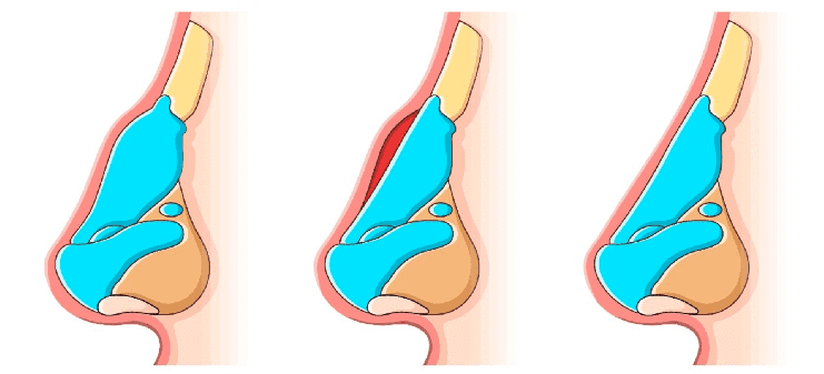 formedi septoplasty surgery