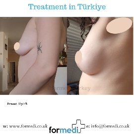 Breast Reduction & Uplift Surgery formedi