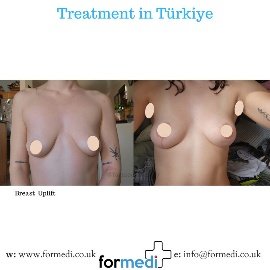 Breast Reduction & Uplift Surgery formedi