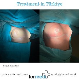 Breast Reduction & Uplift Surgery formedi