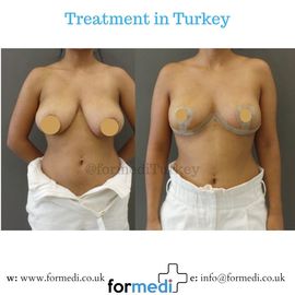 Breast Reduction & Uplift Surgery formedi