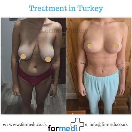Breast Reduction & Uplift Surgery formedi