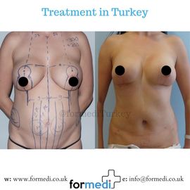 Breast Reduction & Uplift Surgery formedi
