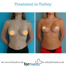 Breast Reduction & Uplift Surgery formedi