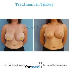 Breast Reduction & Uplift Surgery formedi