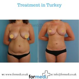 Breast Reduction & Uplift Surgery formedi