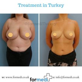 Breast Reduction & Uplift Surgery formedi