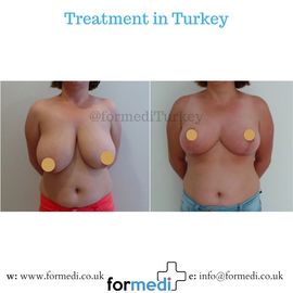 Breast Reduction & Uplift Surgery formedi