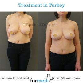 Breast Reduction & Uplift Surgery formedi