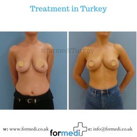 Breast Reduction & Uplift Surgery formedi